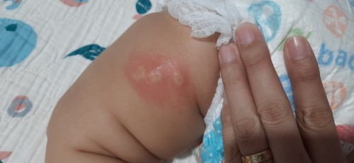 Insect bites?