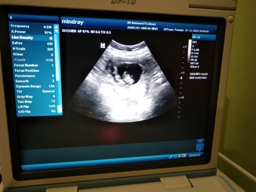 Mau tanya dong bunda aku hamil ga mau mkn lemas bawaan nya muntah trus gimna yg cra nya ilangin mual