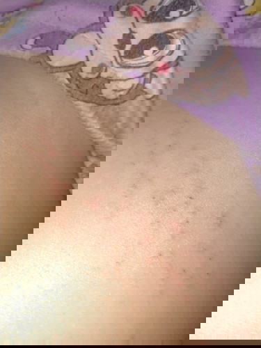 มีผื่นคันขึ้นบริเวณรอบท้อง