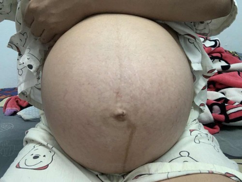 ท้องแตกลายยย