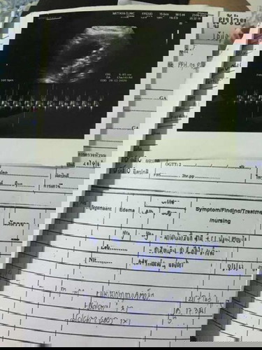 อยากจะมาแชร์ประสบการณ์ที่เจอมาค่ะ อยากฝากแม่ๆ อย่าวางใจหมอมากไปค่ะ เวลาไปตรวจไห้ถามหมอไปเลยอยากรู้อะไรไห้ถามไห้หมดอย่าคิดเองแบบเราค่ะ