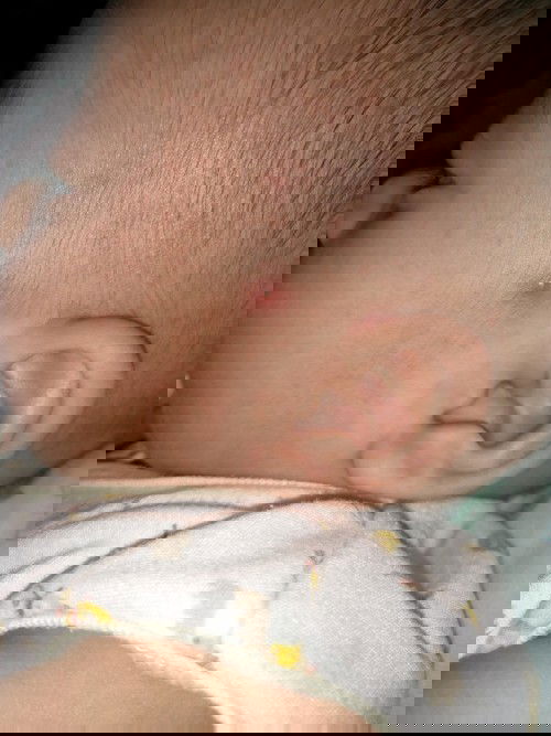 Mirip jerawat pada kepala bayi