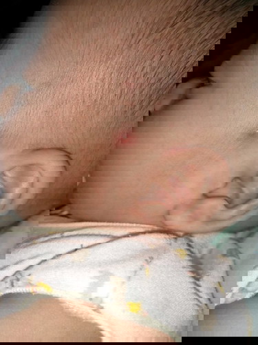 Mirip jerawat pada kepala bayi