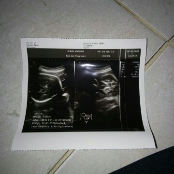 Usg kata pak dokter ddenya kebesaran, hb ibunya rendah,