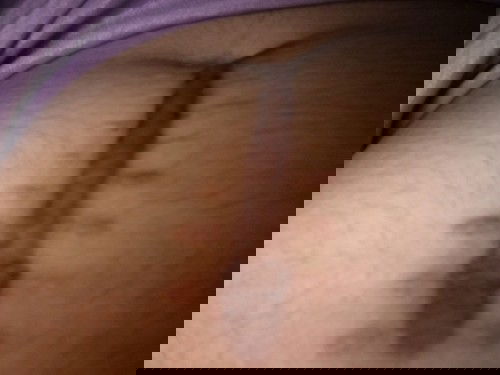 Bekas oprasi usus buntu