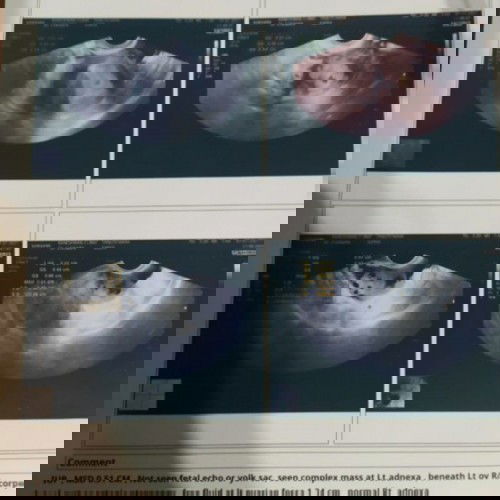 สอบถามประสบการณ์คุณแม่ค่ะ