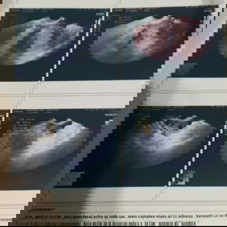 สอบถามประสบการณ์คุณแม่ค่ะ