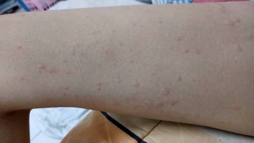 ผื่นแดงเป็นบ่อยตอนเย็นตอนกลางคืน