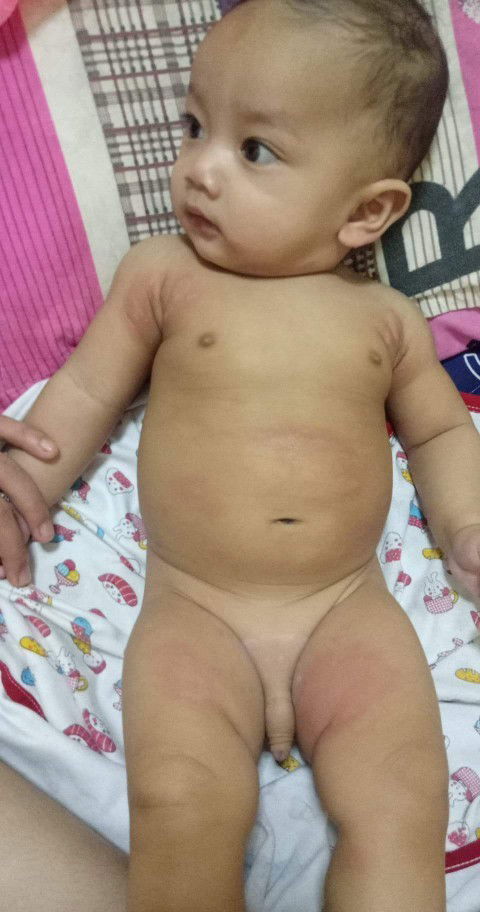 น้องขึ้นผื่นแดง