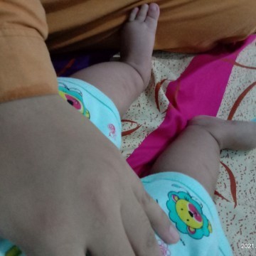 telapak kaki seperti bengkak