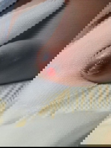 Granuloma Umbilikalis