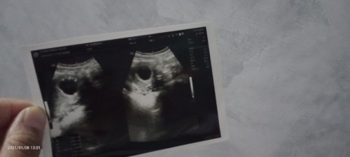 9 Minggu di USG hasilnya BO. 
Apa ada yg seperti saya bunda?