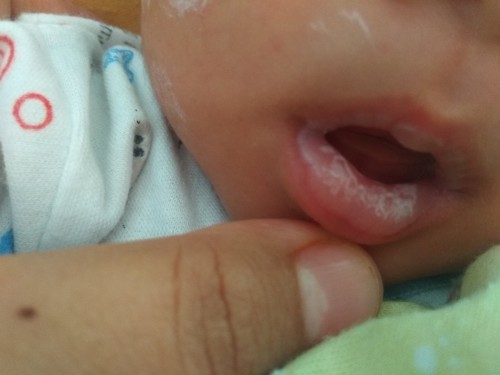 jamur mulut