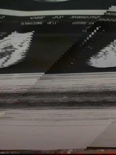 Pacomment nman po aq ng baby girl ultrasound nyo, ππππβ€β€β€ sana baby girl din sakin.. Hoping!