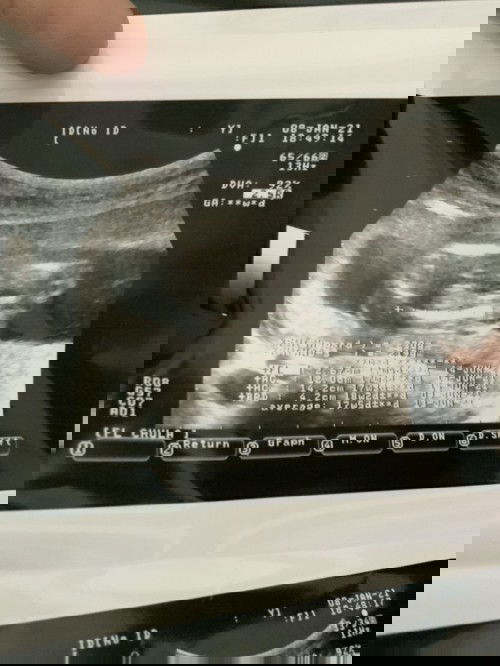 17 วีคแล้ว แม่ๆทายกันหน่อย ชายหรือหญิงคะ ส่วนตัวอยากได้ผู้ชายค่ะ