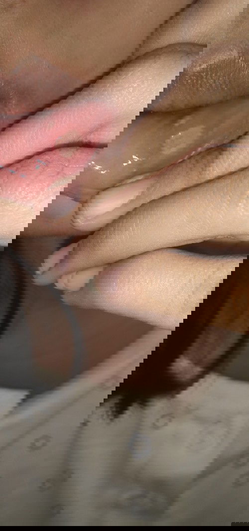 Sariawan😭😭😭