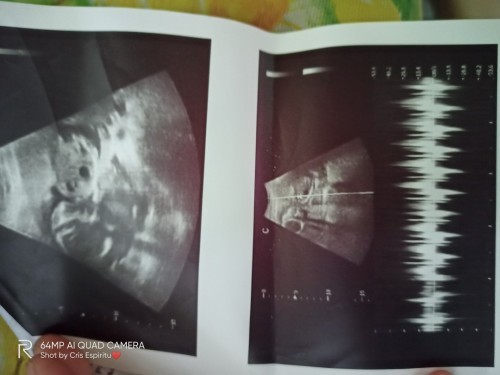 Baket dpa kya nakita gender ni baby 18 weeks aq nagpa ultrasound?
Sabe ni doc.breech position daw