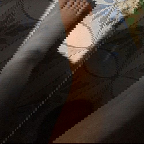 เท้าบวมข้างเดียวชานิดหน่อย