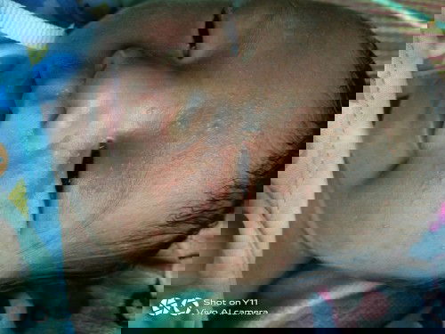 สอบถามเรื่องตุ่มที่ขึ้นบริเวณหน้าน้องหน่อยค่ะ