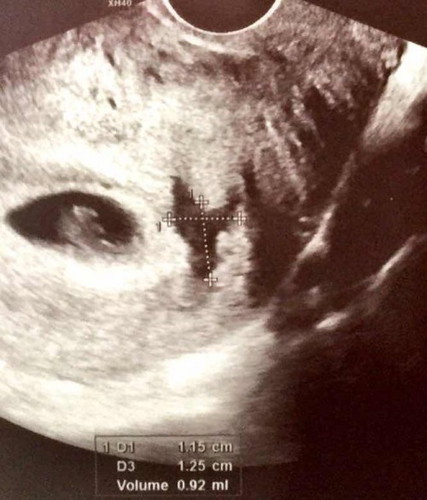 Corpus Luteum and Subchronic Hemorrhage