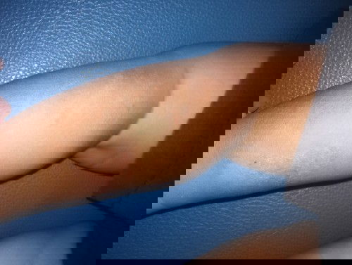 น้อง1ขวบ ผิวแห้งคัน