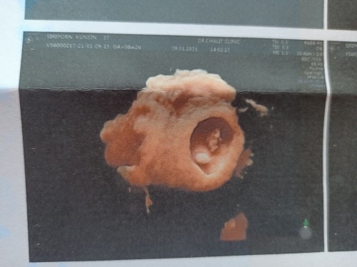 เป็นว่าที่คุณแม่ลูก 3 แต่ตรวจพบว่ามีถุงน้ำในรังไข่ 7 cm. ตอนนี้คุณหมอบอกว่ายังทำอะไรไม่ได้