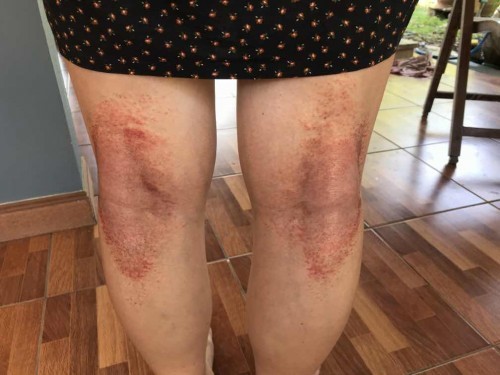 ผื่นขึ้นแบบนี้อันตรายไหมคะ รบกวนด้วยค่ะ