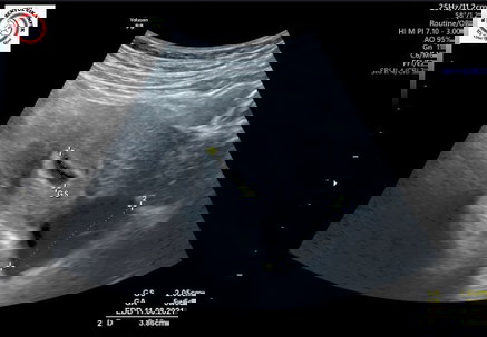 Sungguh berat ketika USG ada kista di saat hamil semoga ada keajaiban di tahun 2021 ini