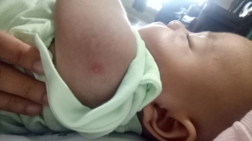 Anak bisulan obat dan cara mengatasinya apa ya bund biar ga muncul terus?