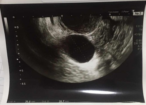 ซีสต์ ในรังไข่