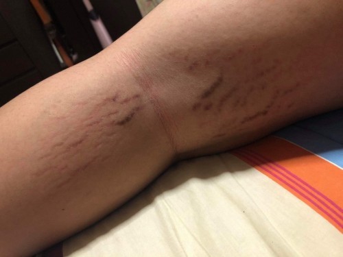 แม่ๆขาแขนแตกลายมั้ยคะ