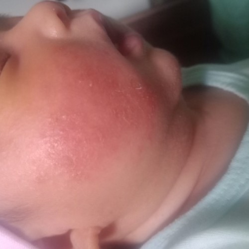 Chàm sữa sơ sinh