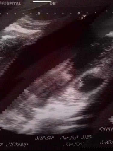 ตั้งครรภ์ได้8สัปดา