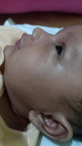 Anak saya umur 1 bulan. Kenapa ya setelah mandi kulit wajahanya ada bagian yg merah" dan bintik
