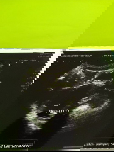 5สัปดาห์2วันแม่ๆคนไหนเป็นเหมือนกันบ้างค่ะ😔ไม่เห็นตัวเด็กค่ะแอบกลัว