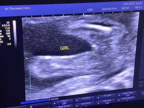 ช่วยคิดชื่อเล่นหน่อยค่ะ 17 w+3 ได้ลูกสาวค่ะ 🥰👧🏻