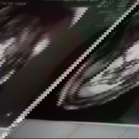 Saya mengalami pendarahan sejak hari sabtu.dan sampai saat ini masih flek padahal sudah dikasih obat