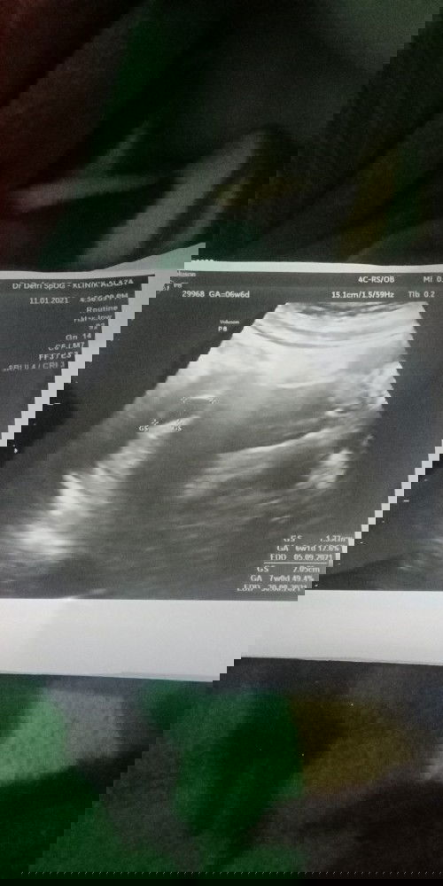 Hamil 6w6d masih terlihat kantong janin