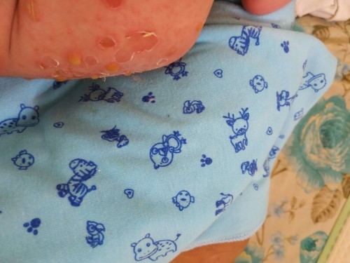 bintik kuning berair pada bayi