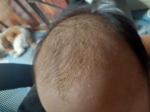 Dandruff / Dry