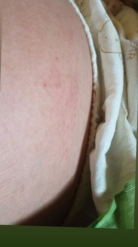 สอบถามหน่อยค่ะ
ท้องได้33+3
มีตุ่มใสๆขึ้นและคันจะเป็นไรไหมค่ะ
ท้องแรกคะ