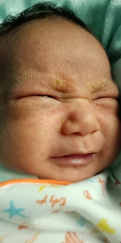 นี่คืออะไรค่ะน้องเป็นผื่นหยาบๆแล้วมีเหลืองๆคลายไขอะไรสักอย่าง?จับลูบดูสากๆค่ะ