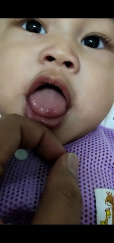 Anak saya dah 2 hari ada tompok merah di hujung lidah dia. Perlukah saya risau?