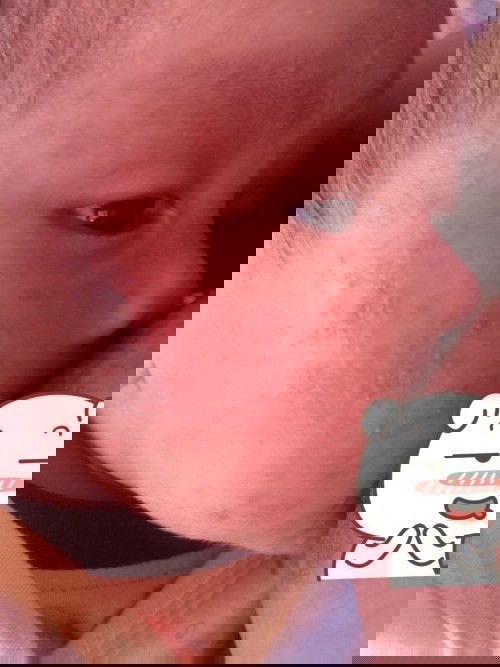 แพ้อ่ะไรค่ะแบบนี้