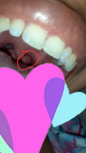 Benjolan di kerongkonhan tolong bantu dijawab