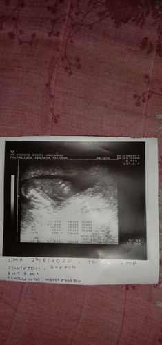 Belum terasa gerakan bayi normal ke minggu 19 hari 5 belum terasa gerakannya