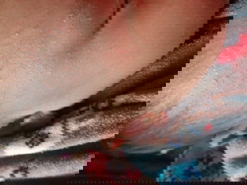 น้องอายุ1เดือนมีผื่นขึ้นหน้า