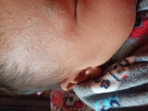 น้องอายุ1เดือนมีผื่นขึ้นหน้า