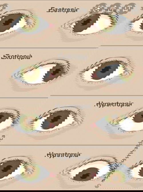 Strabismus