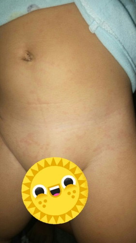 Good pm!
Ask ko lang po ano kaya ito? Galing sya sa lagnat gawa ng pagngingipin e. TIA